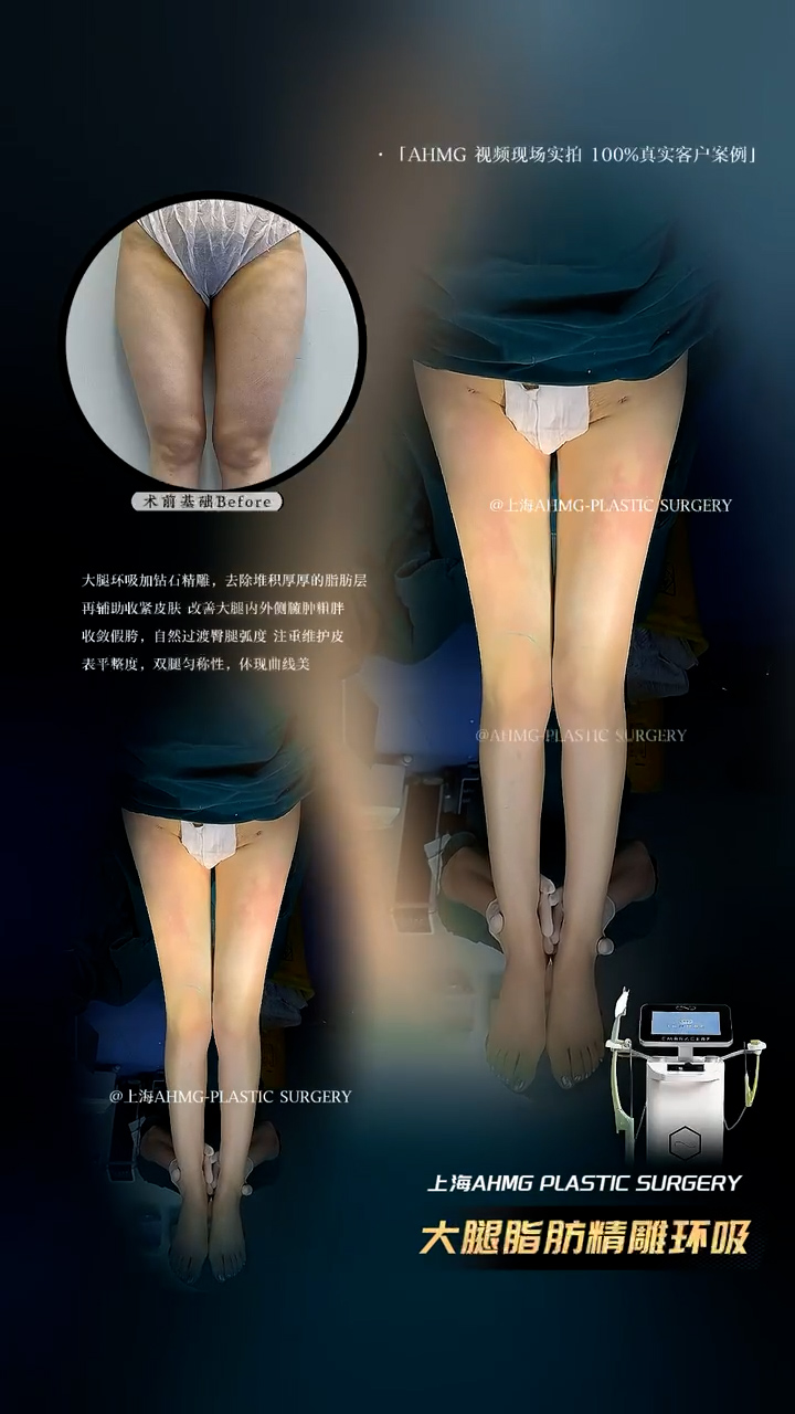 大腿环吸